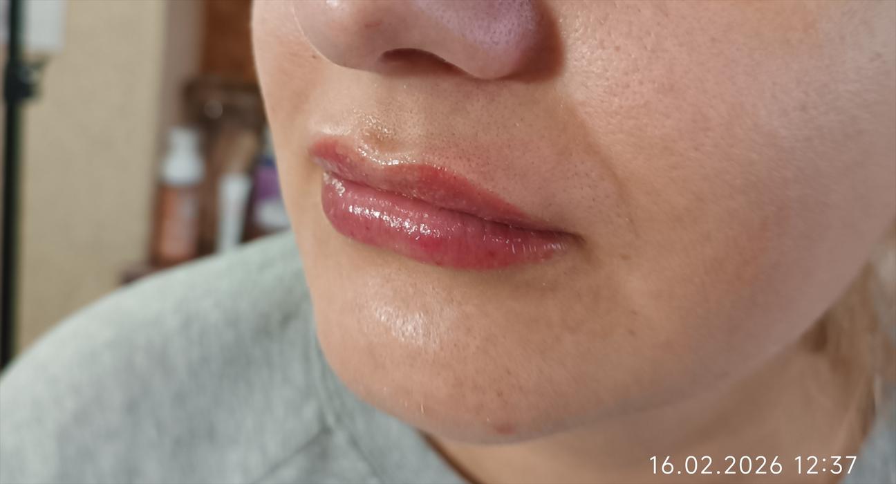 Косметологія, контурна пластика губ. фото 1
