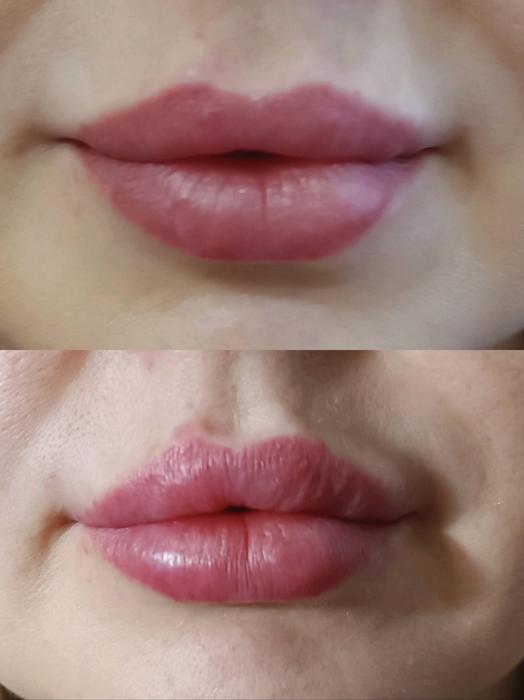 Косметологія, контурна пластика губ. фото 2