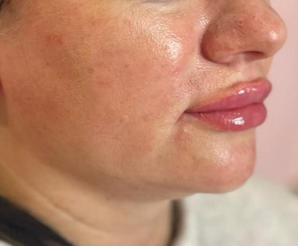 Косметологія, контурна пластика губ. фото 3
