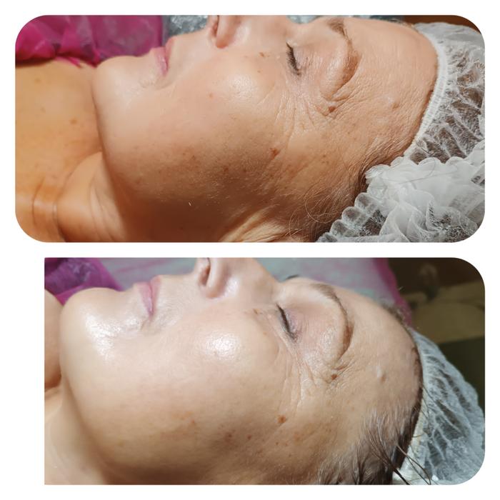 Косметологія, контурна пластика губ. фото 4