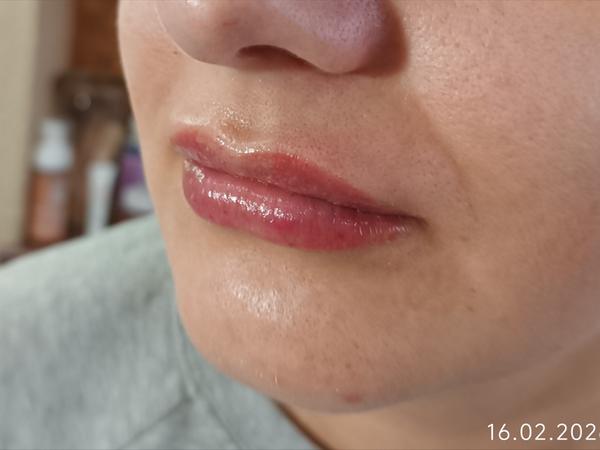 Косметологія, контурна пластика губ. фото